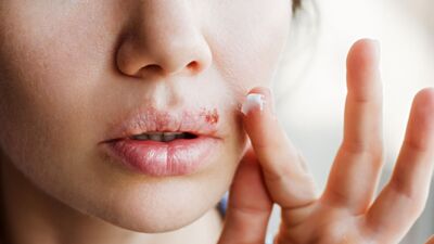  Herpes labiale: rimedi, farmaci e tutti i Consigli Pratici 