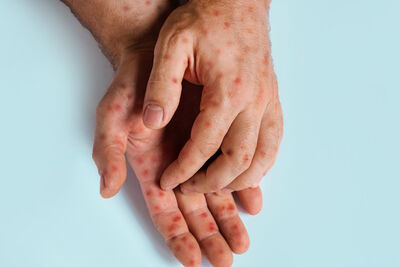  Boom di morbillo negli Stati Uniti: il peggiore focolaio dal 2000 