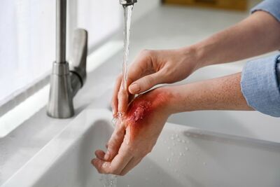  Ustioni di terzo grado: cosa sono? Cause, Sintomi e cura 