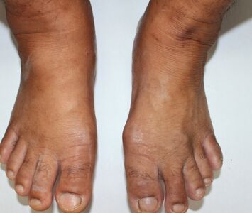  Come posso sgonfiare le caviglie? 