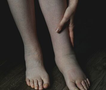  Linfedema: cos’è? Sintomi e Cause del ristagno di linfa 