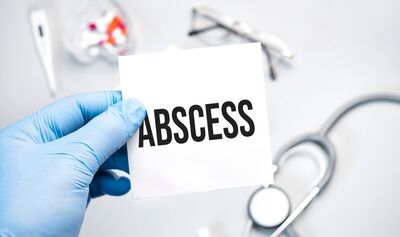  Ascesso: cos'è e Come si riconosce? Come si cura? 