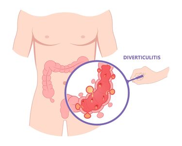  Diverticolite: quali sono i sintomi e come si presenta, cause e quali cibi evitare 