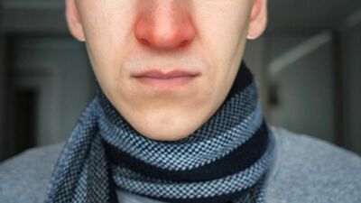  Naso arrossato e screpolato: trattamento, cause e rimedi naturali 